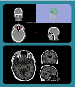 Image of MVision AI's guideline-based Brain CT Model and Brain MR Model